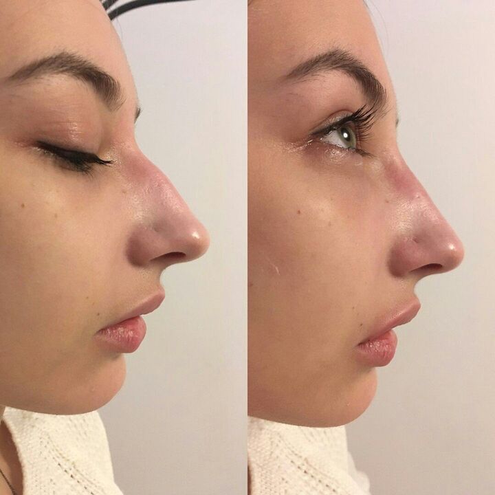 Correction du nez