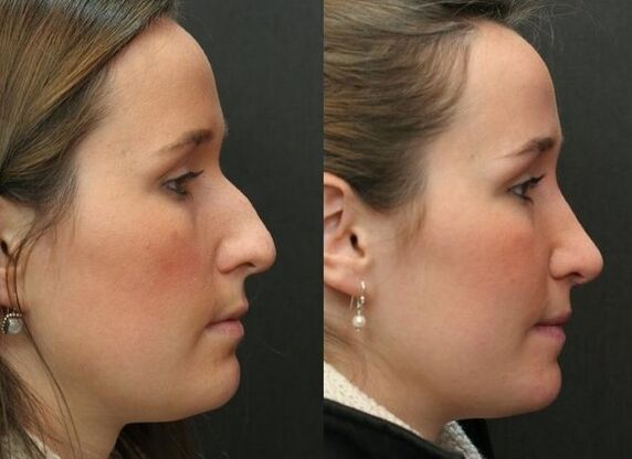Avant et après la rhinoplastie non chirurgicale