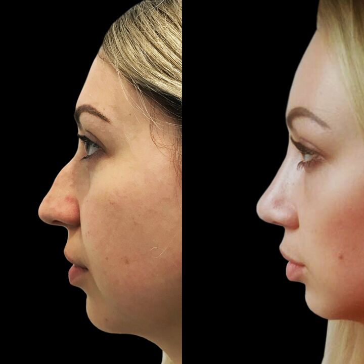 Rhinoplastie