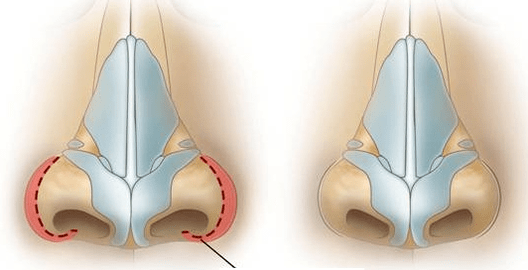 Réduction des voies nasales