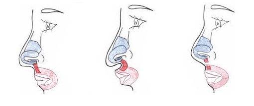 Troncature d'une partie du muscle nasal.