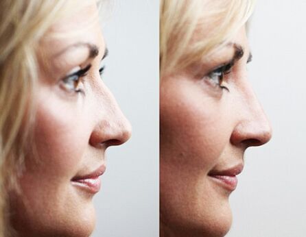 Avant et après rhinoplastie avec fillers