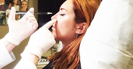 Procédure de rhinoplastie avec fillers.