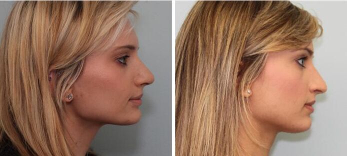 Résultats de rhinoplastie avant et après