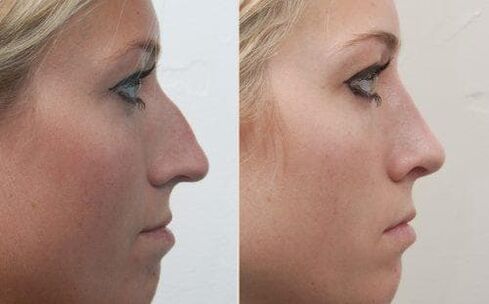 Avant et après une rhinoplastie non chirurgicale