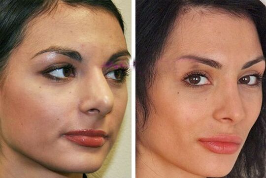 nez avant et après chirurgie esthétique