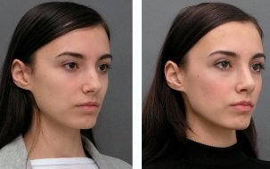 Les filles avant et après la Rhinoplastie Nez